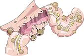 complementary and alternative therapies for diverticulitis