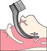 Clip Art of Endotracheal Intubation-Intubating endotub2 - Search ...